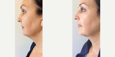 ThermiTight Neck & Jowls - The 62-year-old female patient was concerned with her sagging neck and jowls. ThermiTight is a nonsurgical, minimally invasive skin tightening treatment.