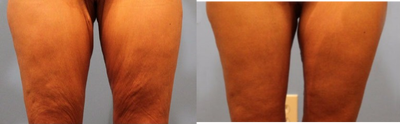 Thigh Lift - Thigh Lift