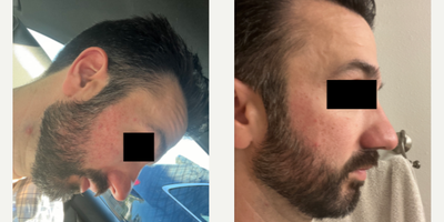 35-44 year old man treated with Revision Skincare - Rosacea