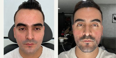 25-34 year old man treated with CO2 Laser, Punch Excision, Fractional Laser - My patient had always dreamed of reducing these harsh scars, which made him feel very self-conscious. He wanted to be treated for years but did not trust anyone in Florida to help him because he knew he was a sensitive skin type.  He had been following me for some time then came to me as soon as he saw that we visit MIAMI.  After one combination treatment, we saw a substantial improvement, but we have a game-plan to target the rest of them. The key is our skincare regimen - it's important to use between treatments.  ACNE SCAR COMBINATION  Punch Excision  Fractional laser  CO2 LASER EmerSkinTAG A BEST FRIEND WHO MAY WANT THIS TREATMENT 
