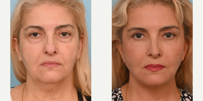 Woman treated with Facelift - Woman treated with Facelift
