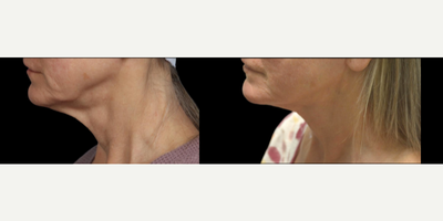 55-64 year old woman treated with Neck Lift - Minimally invasive neck lift.
