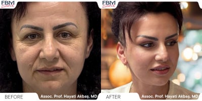 55-64 year old woman treated with Deep Plane Facelift - .