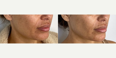 35-44 year old woman treated with Restylane Lyft - Jawline enhancement