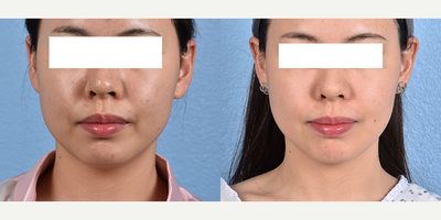 28 year old woman treated with Thermage FLX - This patient had Full Face and Neck Thermage FLX Treatment. The after images are shown at 1 month post treatment.
