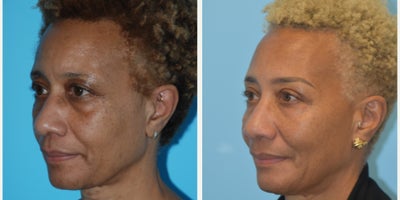 55-64 year old woman treated with Eyelid Surgery, Neo Laser, Dermal Fillers, Botox, Morpheus8 - This patient is shown 6 years after her initial photo.  She underwent neurotoxin, filler to the midface, morpheus skin tightening, aerolase neo treatments, microneedling, hydrafacials and regular skin care use.  Additionally, she is shown 1 month after upper blepharoplasty.  Looking the like herself but has aged backwards.