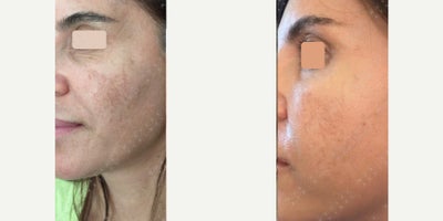 35-44 year old woman treated with Dermapen - She came for skin treatment and otoplasty. Had laser procedure for the face previously but experienced a hyperpigmentation complication. Dermapen, fat grafting, and facial rejuvenation was performed along with use of an exosome cream for a month. Note how the fine wrinkles and the skin tone and skin texture is improved.