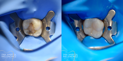 18-24 year old woman treated with Dental Bonding - Composite bonding. Cavity remotion on molar with composite restoration.