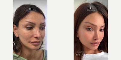 Woman treated with Cheekbone Reduction - Woman treated with Facial Feminization Surgery through Forehead Reduction (Hairline Advancement), Brow Bone Reduction, Facelift, Jaw Reduction, T Genioplasty, Rhinoplasty, and subnasal Lip Lift. Patient is shown before and 3 weeks post-op.