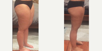 25-34 year old woman treated with Liposuction for lipedema - Woman in her early 30's was diagnosed with stage 1 Lipedema. Liposuction surgery was performed for cirumferential thighs, calves, ankles and knees.