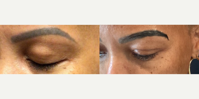 45-54 year old woman treated with Eyebrow Transplant - Eyebrow Transplant 1-year post-op.