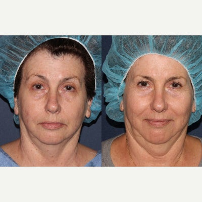 45-54 year old woman treated with Deep FX - A woman receives a Deep FX laser treatment to reduce signs of aging including uneven skin tone and pigmentation.