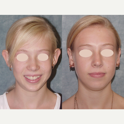 Ear Surgery before and after photo
