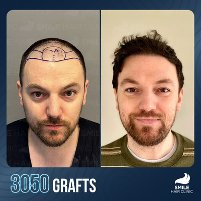 Hair Loss Treatment before and after photo