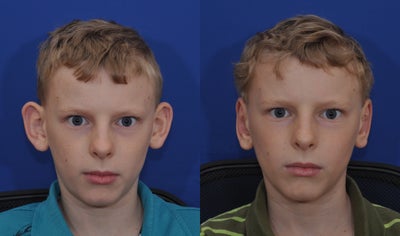 Ear Surgery before and after photo
