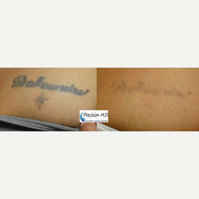 Tattoo Removal before and after photo