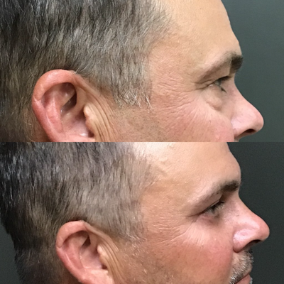 Eyelid Surgery before and after photo