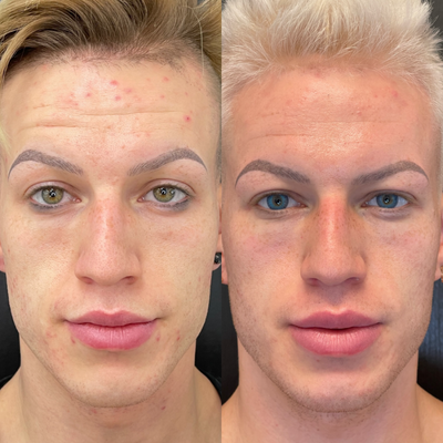 HydraFacial before and after photo