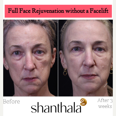 3DMIRACL before and after photo