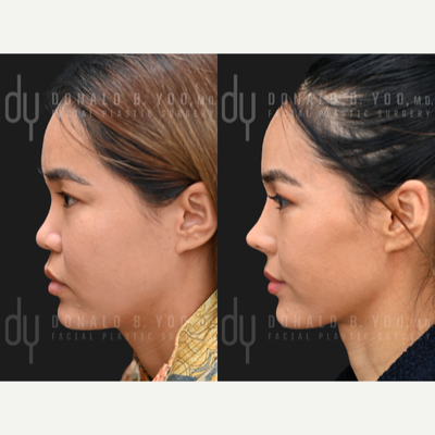 Asian Rhinoplasty before and after photo
