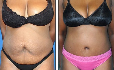 Tummy Tuck before and after photo
