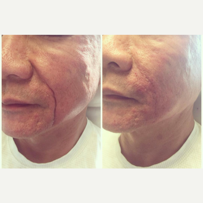 Contour Thread Lift before and after photo
