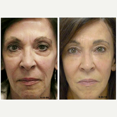 Sculptra before and after photo