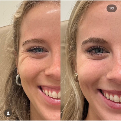 Botox before and after photo