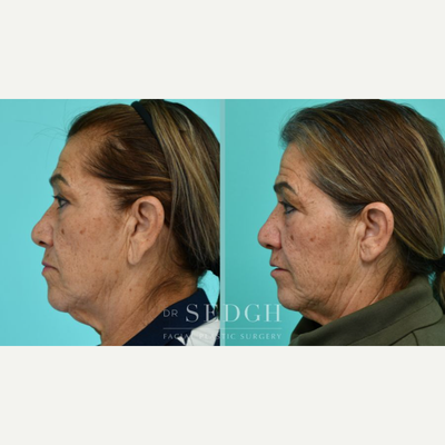 before and after image