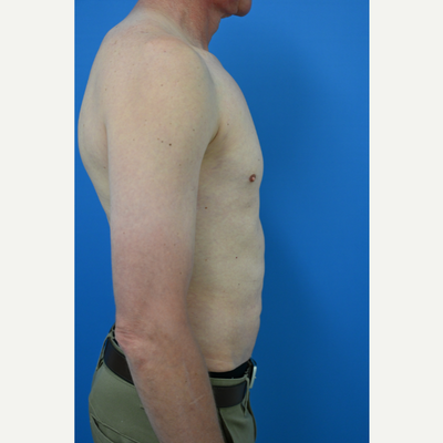 Pectoral Implants for Men - Achieve a Muscular, Well-Defined Chest