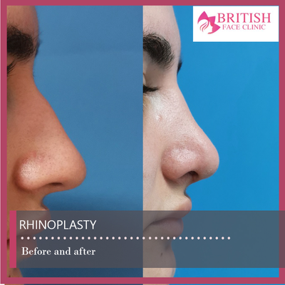 Rhinoplasty before and after photo