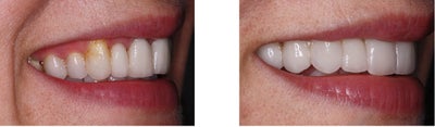 Smile Makeover before and after photo