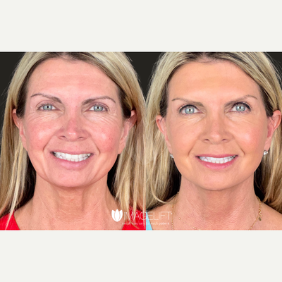 Neck Lift before and after photo
