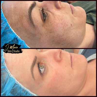 Chemical Peel before and after photo