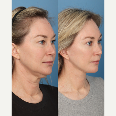 Deep Plane Facelift before and after photo