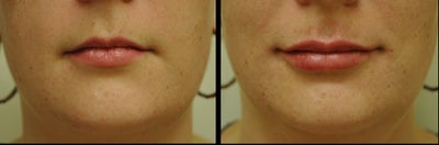 Lip Fillers before and after photo