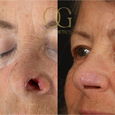 Mohs Surgery before and after photo