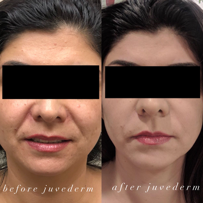 Juvederm before and after photo