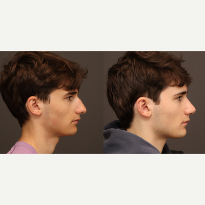 Rhinoplasty before and after photo