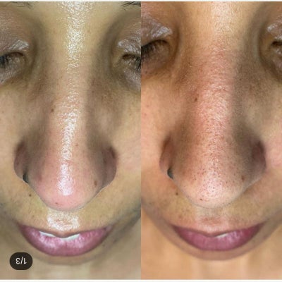DiamondGlow before and after photo