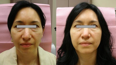 Botox before and after photo
