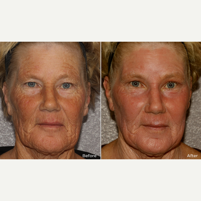 CO2 Laser before and after photo