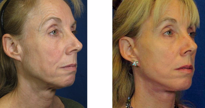Facelift before and after photo