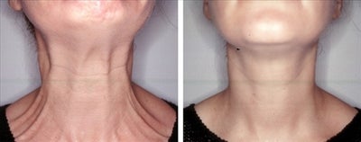 Botox before and after photo