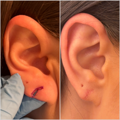 Earlobe Repair before and after photo