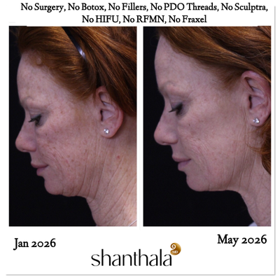 Nonsurgical Facelift before and after photo