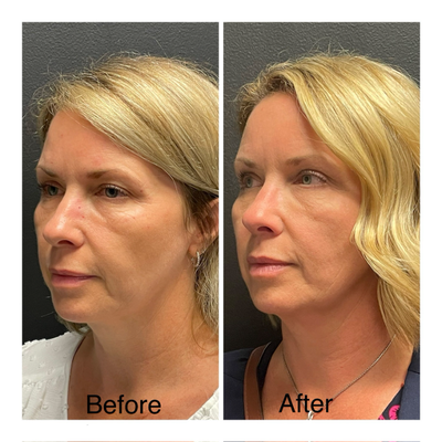 Eyelid Surgery before and after photo