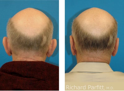 Ear Surgery before and after photo