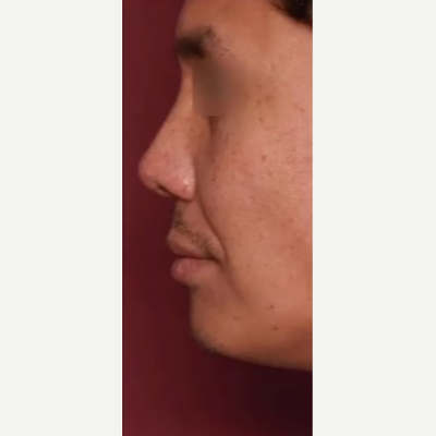 Nonsurgical Nose Job: How Liquid Rhinoplasty Works
