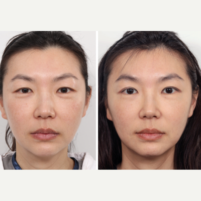 Brow Lift before and after photo